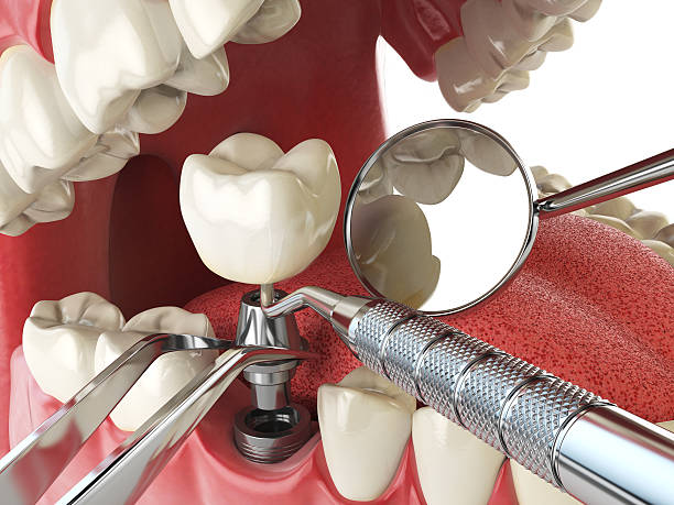 Best Emergency Root Canal Treatment in Cold Springs, NV